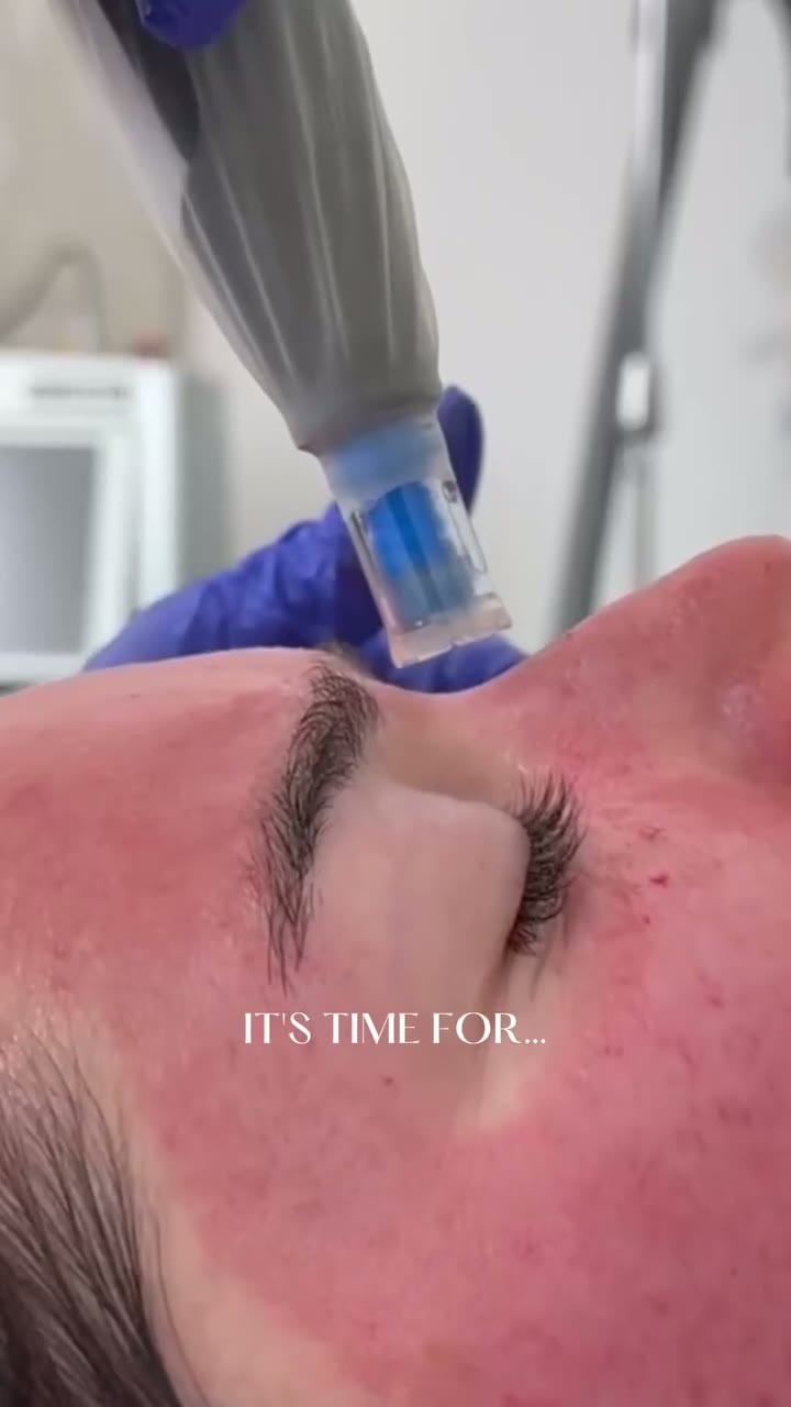 Reel cover: when it’s time to book microneedling