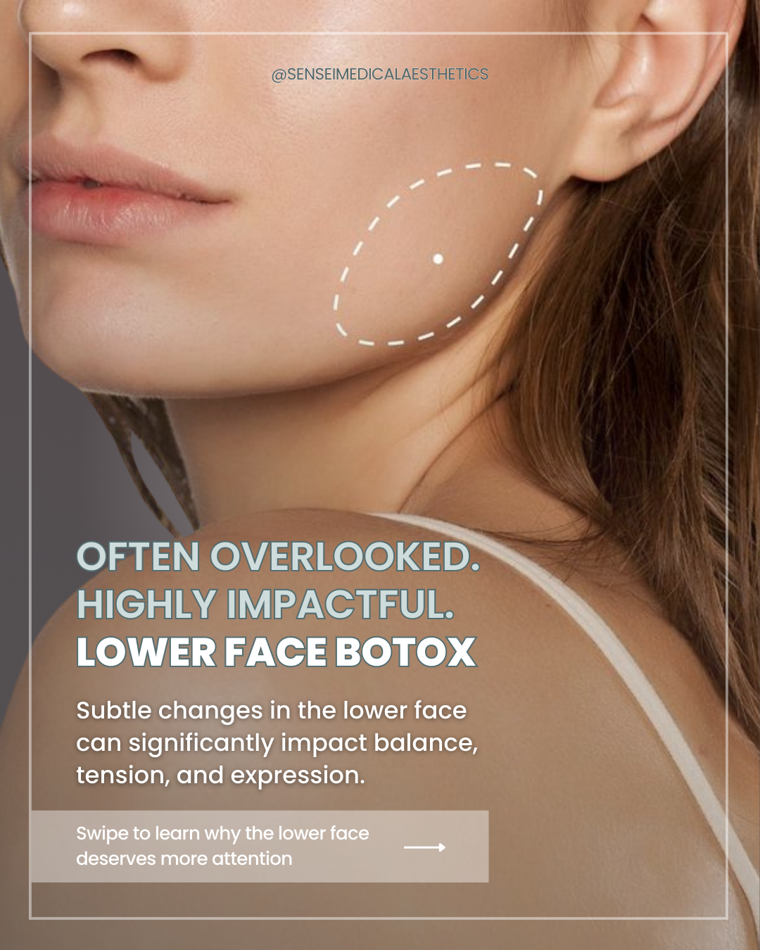 Instagram carousel: lower face Botox education, “Often overlooked. Highly impactful.”